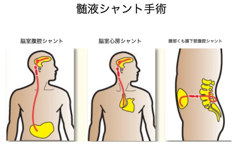 髄液シャント手術