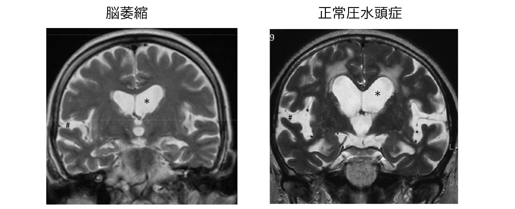 MRI画像（冠状断）での脳萎縮と正常圧水頭症の違い